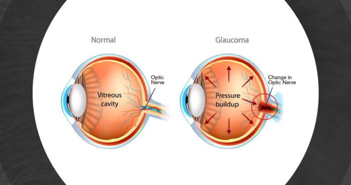 Glaucoma