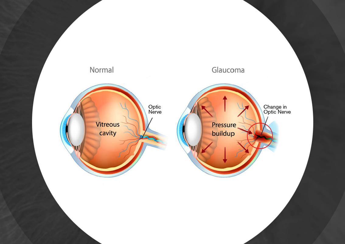 Glaucoma