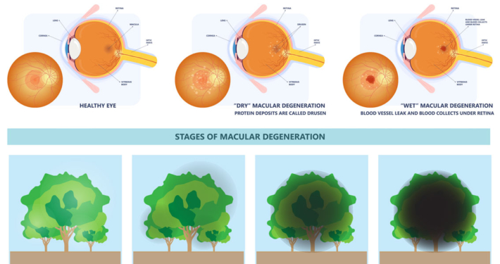 Macular Degeneration