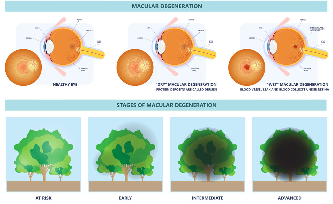 Macular Degeneration